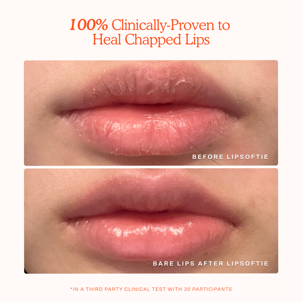 LipSoftie® Lip Treatment U2