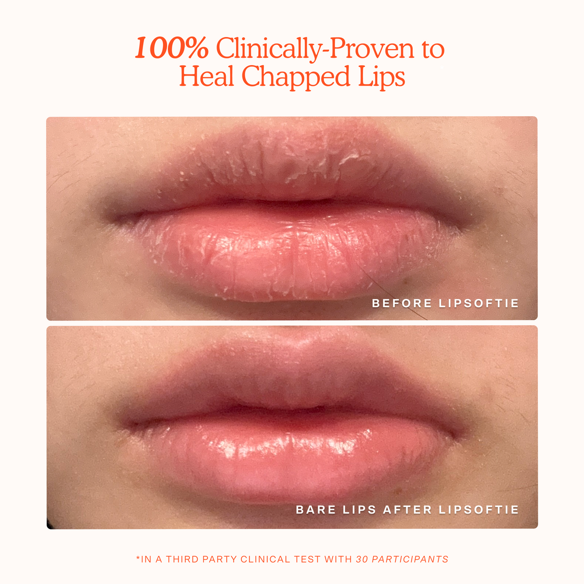 LipSoftie® Lip Treatment U2