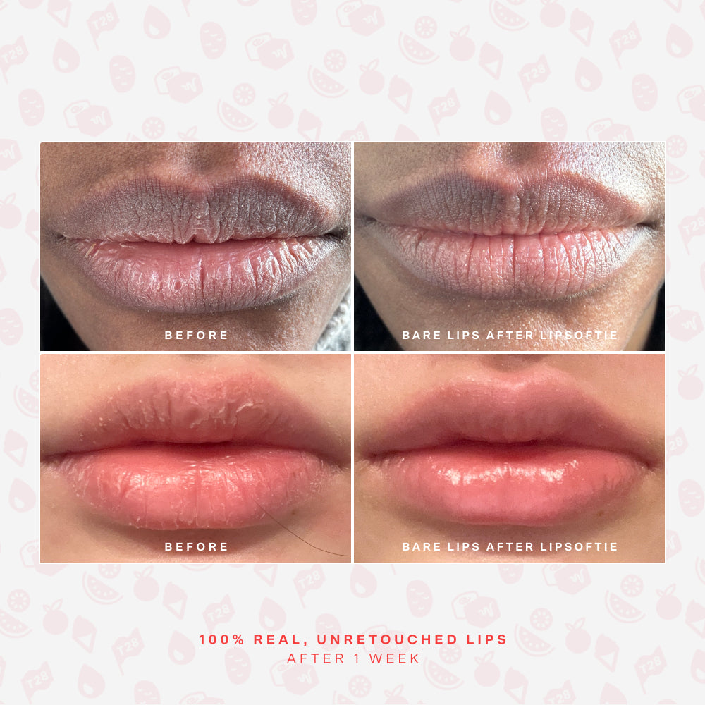 LipSoftie® Lip Treatment Set K5
