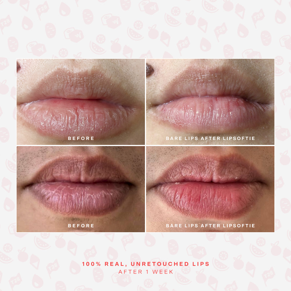 LipSoftie® Lip Treatment Set K5